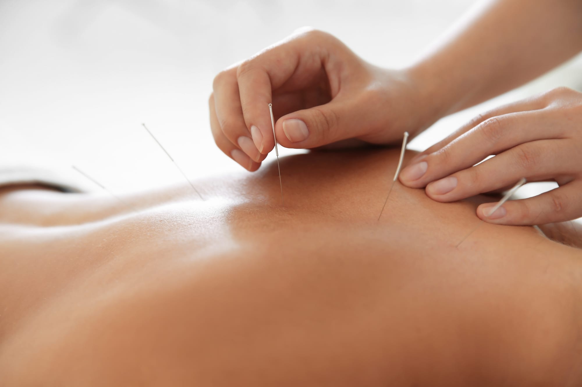 Dry needling treatment — acupuncture needles in upper back at Flow State Therapies Melbourne CBD