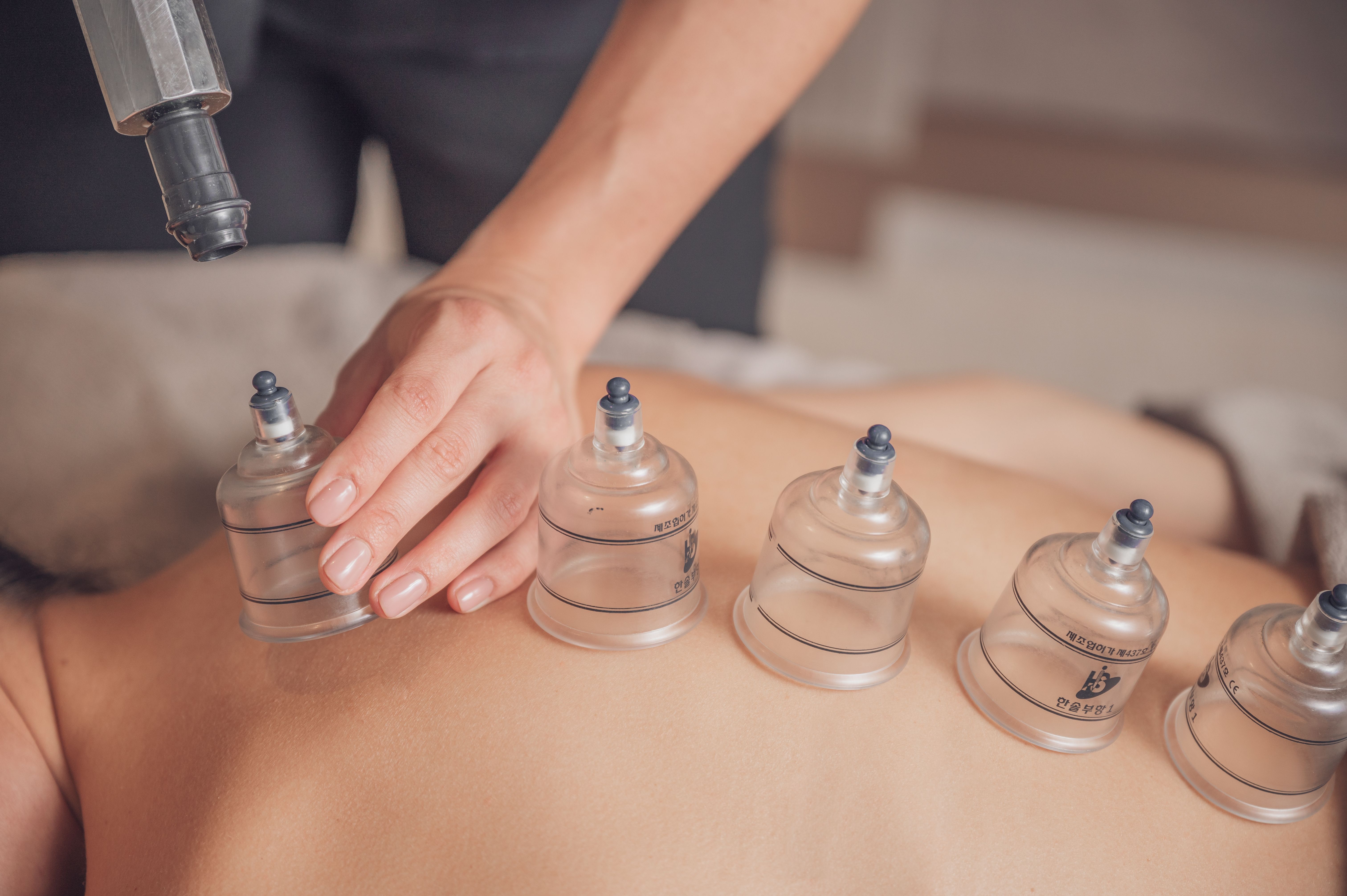 Cupping therapy session at Flow State Therapies Melbourne CBD